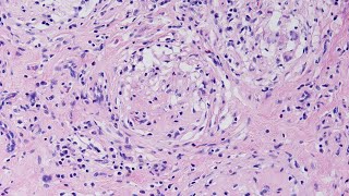 A Case of Granulomatous Orchitis  Pathology mini tutorial [upl. by Ashley]