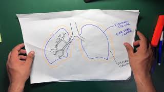 Managing Malignant Pleural Effusions Pleurodesis [upl. by Ramyaj]