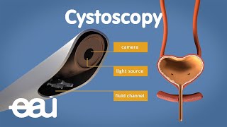 Recovery Length from Superficial Bladder Cancer Surgery  Questions About Bladder Cancer [upl. by Peyter]