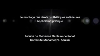 Montage des dents prothétiques antérieures [upl. by Nylaroc565]