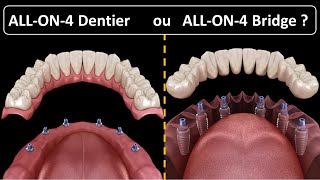 All on 4  Type de prothèse  Dentier ou Bridge [upl. by Canada]