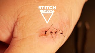 How to Remove Stitches from Home [upl. by Nidya]