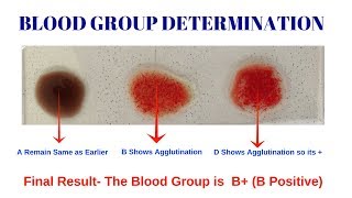 Blood Group Test  Procedure for Determination of Blood Group  Blood Group Determination Test [upl. by Noirred764]