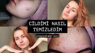 SİVİLCELERİMDEN NASIL KURTULDUM ✨ roaccutane’sız [upl. by Morven]