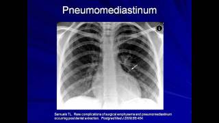 Lung Protective Ventilation Mechanical Ventilation  Lecture 9 [upl. by Nnaaras]