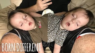 Conjoined Twins Are A Medical Miracle  BORN DIFFERENT [upl. by Diao13]