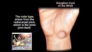 Ganglion Cyst Wrist  Everything You Need To Know  Dr Nabil Ebraheim [upl. by Carmina]