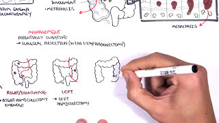 Colorectal Cancer  Overview [upl. by Chrysa393]