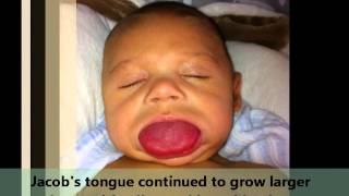 Trisomy 21 Down Syndrome Introduction – Pediatrics  Lecturio [upl. by Yarehs724]