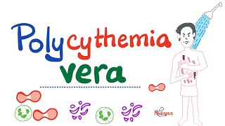 Polycythemia Vera PV  Myeloproliferative Neoplasm MPN  Erythrocytosis  Hematology [upl. by Iem]