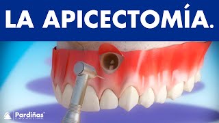 Apicectomía  Tratamiento infección de la raíz del diente © [upl. by Archibald817]