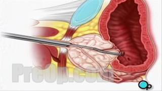 TURP Transurethral Resection Prostate Surgery patient education series [upl. by Ireg410]