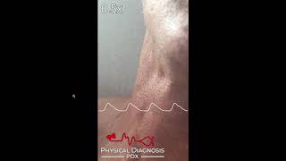 Jugular Venous Pulse Identification [upl. by Annovad]