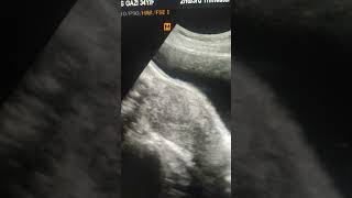 Bicornuate Septate uterus [upl. by Nauqal]