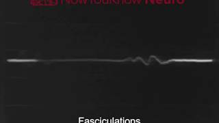 EMG Fasciculations [upl. by Rafaelof]