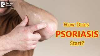 How does psoriasis start Main Causes amp Symptoms  Dr Chaithanya K S  Doctors Circle [upl. by Marella]