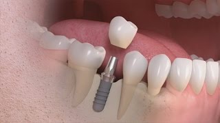 Straumann  Trattamento singolo dente su impianto [upl. by Novart877]