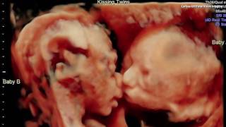 Ultrasound Captures Sweet Moment Between Twins in the Womb [upl. by Osbourn625]