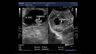 Ultrasound Video showing a case of missed miscarriage of about 7 to 8 weeks [upl. by Eirdua]