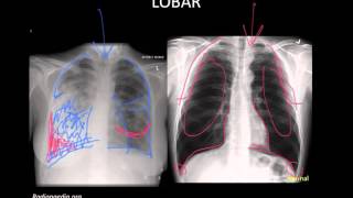 Pneumonia Imaging [upl. by Noxid]