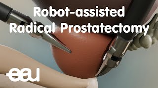 Robotassisted Radical Prostatectomy RARP [upl. by Guttery827]