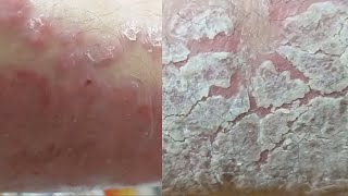 EXTREME REGENERATION 1 WEEK AFTER FULL CLEANING Psoriasis [upl. by Tenaej626]