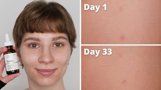 The Ordinary Ascorbic Acid 8  Alpha Arbutin 2 Dark Spots Results  1 Month with Pictures [upl. by Arehc]