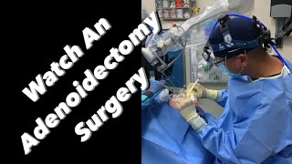 Adenoidectomy  actual footage [upl. by Eirlav]