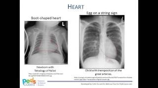 pleural effusion vs atelectasis [upl. by Griff]