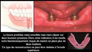 Prothèse amovible et implants dentairesMandibular overdentures [upl. by Asiole]