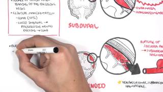 Intracranial Haemorrhage Types signs and symptoms [upl. by Erle5]