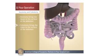 ColostomyIleostomy Your Operation [upl. by Hagile]