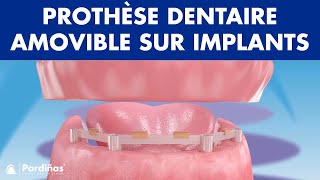 Prothèse dentaire amovible sur implants © [upl. by Ehtnax]