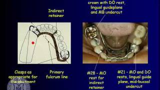 DENT 718 Removable partial dentures design considerations [upl. by Ecinhoj]