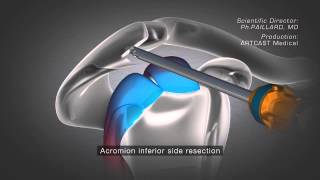 Surgery Video Subchondroplasty [upl. by Hamaso]