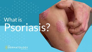 What Is Psoriasis [upl. by Arahahs]