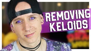 Keloid Causes Signs and Symptoms Diagnosis and Treatment [upl. by Ahsitra238]