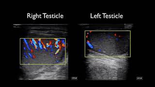 Global Ultrasound Institute Orchitis and Epididymitis on Point of Care Ultrasound [upl. by Cassiani729]