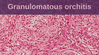 Idiopathic Granulomatous Orchitis  Pathology mini tutorial [upl. by Hadeis]