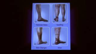 What causes varicose and spider veins Hear Dr Saltis Answer [upl. by Cele]