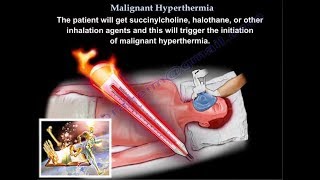 Malignant Hyperthermia  Everything You Need To Know  Dr Nabil Ebraheim [upl. by Teodorico]