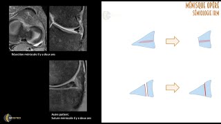 TUTORIEL IMOSTEO  19  Fissurations méniscales Aspects postopératoires [upl. by Grissom330]