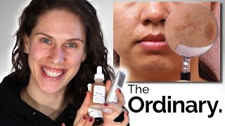 THE ORDINARY  3 BEST DARK SPOTS amp PIGMENTATION PRODUCTS [upl. by Alo]