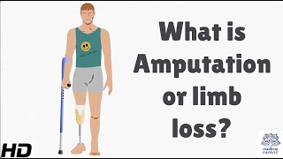 My disability  Why I am amputating my leg [upl. by Thgiwd]