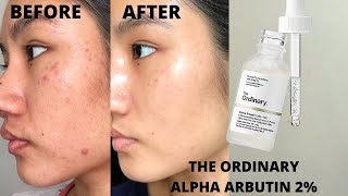 THE ORDINARY ALPHA ARBUTIN 2  HA REVIEW  BEFORE amp AFTER 6 WEEKS [upl. by Nnawaj613]