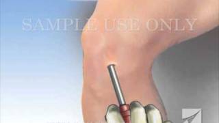 Knee Arthroscopy [upl. by Gettings391]