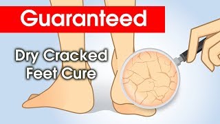 Dry Cracked Feet How to cure [upl. by Lepper]