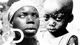 The Eradication Of Smallpox  Invisible Killers [upl. by Lavinia]