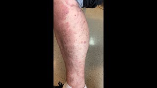 Neuromyotonia Due to Autoimmune Isaacs Syndrome in a Patient With Psoriasis [upl. by Yorgos]