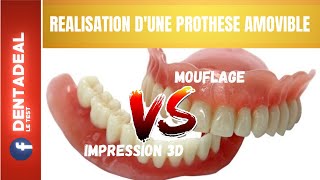 Prothèse Amovible Dentaire  IMPRESSION 3D VS MOUFLAGE [upl. by Atiuqaj]